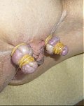 Extrem abgebundene Schamlippen